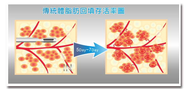 自體脂肪回填存活率圖