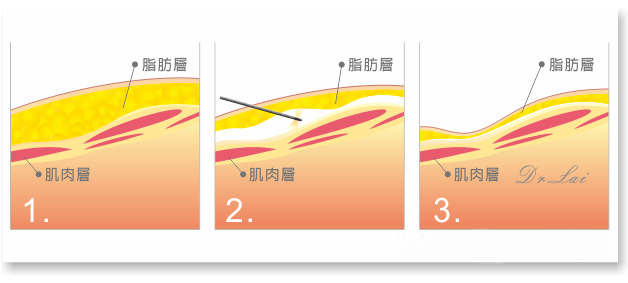 威塑線條雕塑的手術示意圖