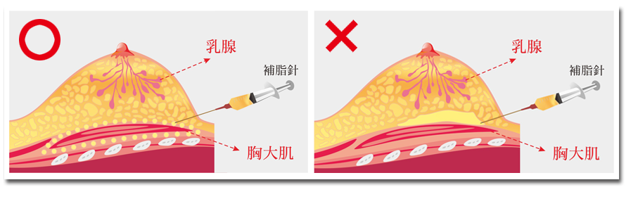 自體脂肪移植隆乳示意圖