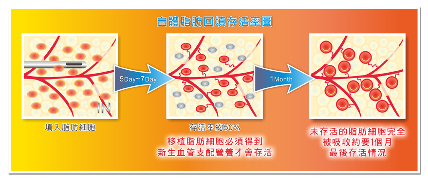 自體脂肪回填存活率圖