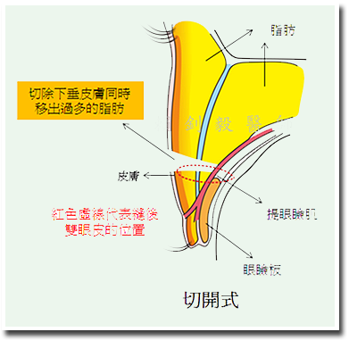 雙眼皮案例