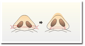 鼻翼手術示意圖