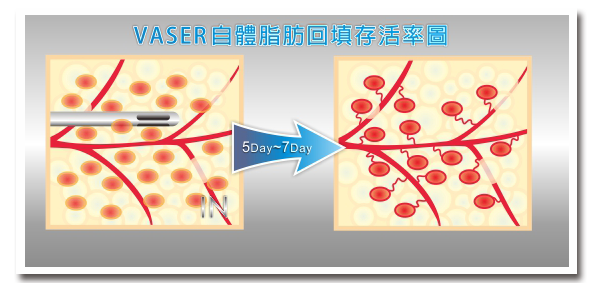 自體脂肪回填存活率圖