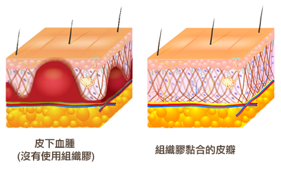 組織膠減少狐臭手術後腫脹示意圖